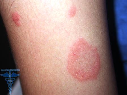 Аллергия на укусы паразитов
